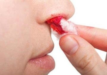经常流鼻血该怎么办？请看...