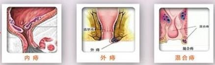痔疮的疼痛