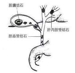 胆结石