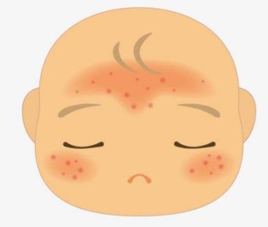 长湿疹不能吃什么食物？治...