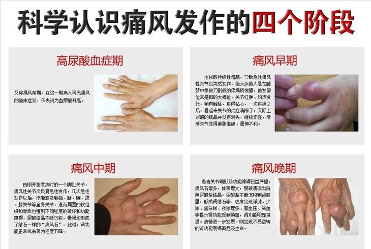 痛风阶段