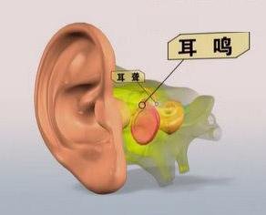 耳鸣吃什么保健品？