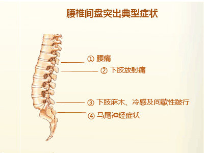 腰间盘突出