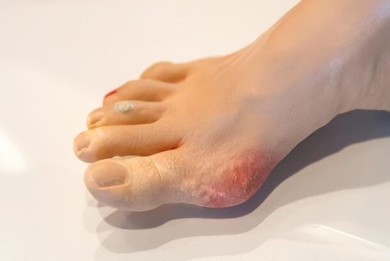 糖尿病足是什么样子
